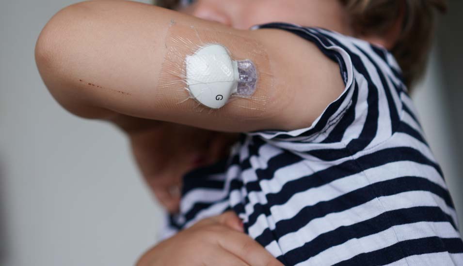 Diabetes mellitus Typ 1 bei Kindern: Ein vierjähriger Junge zeigt einen Sensor an seinem Arm, der seinen Blutzucker misst.