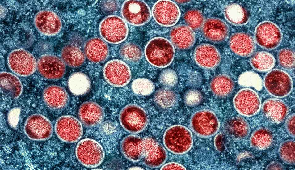 Eingefärbte Mikroskop-Aufnahme von Mpox-Erregern (rot) innerhalb von infizierten Zellen (blau).