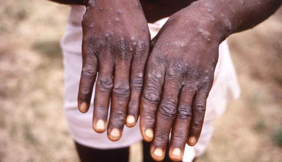 Nahaufnahme von Händen eines Mannes im Kongo, der wegen einer Affenpocken-Infektion einen Hautausschlag hat 